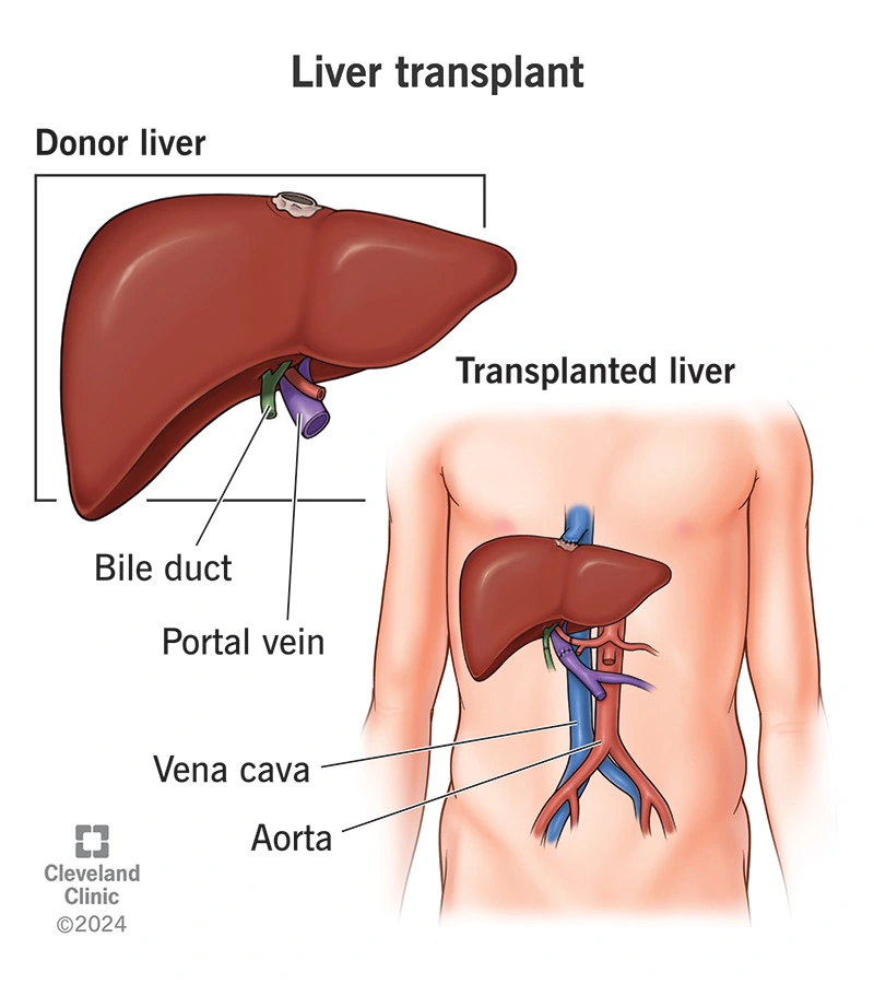 Liver Transplant Surgery Cost in India