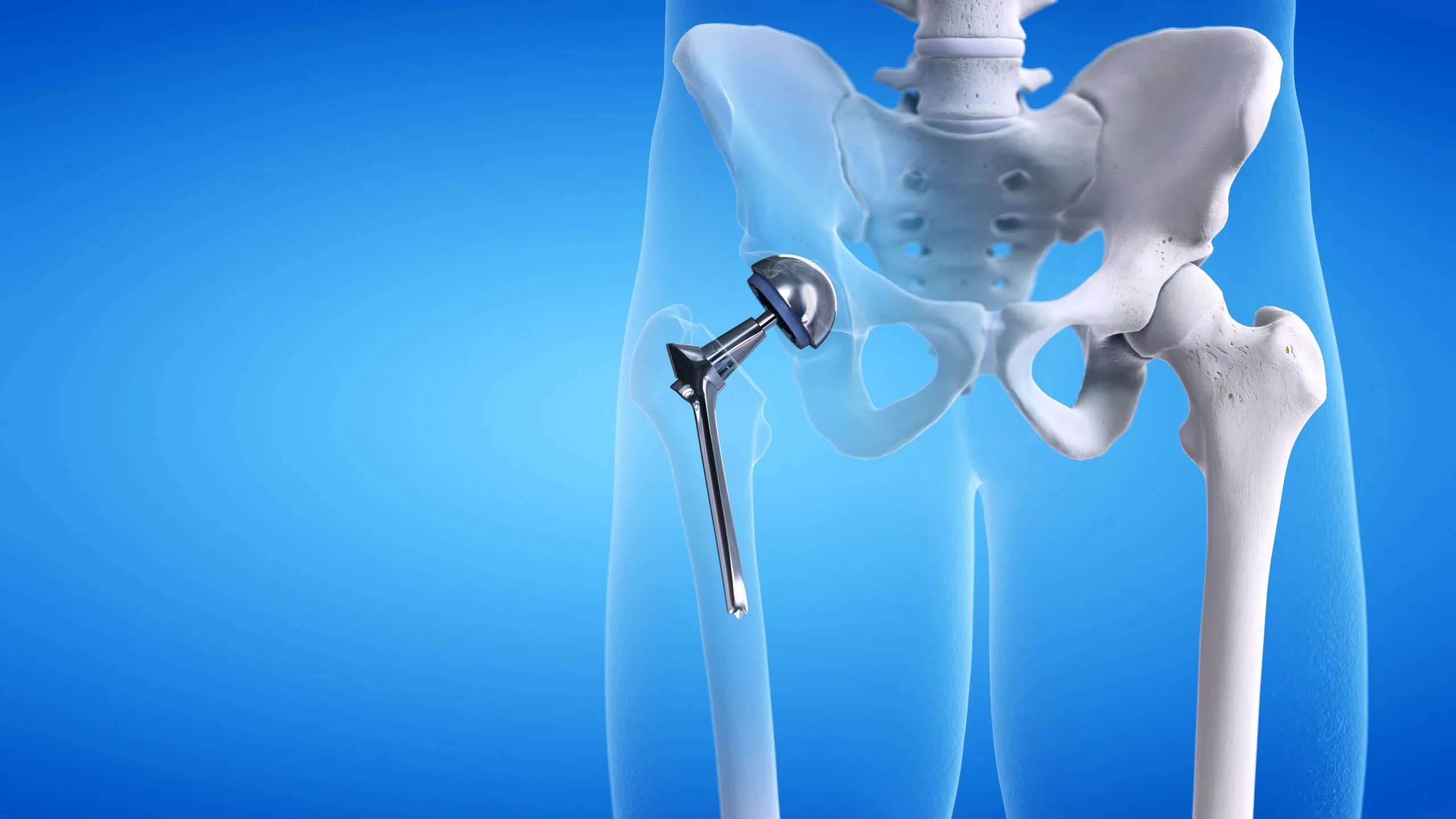 what is the cost of hip replacement surgery in india