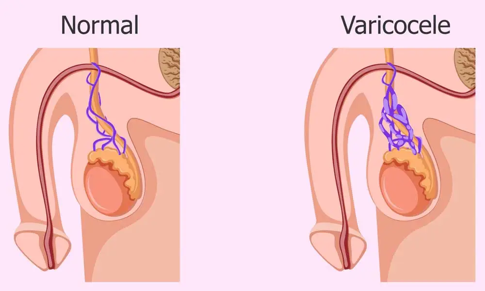 varicocele surgery