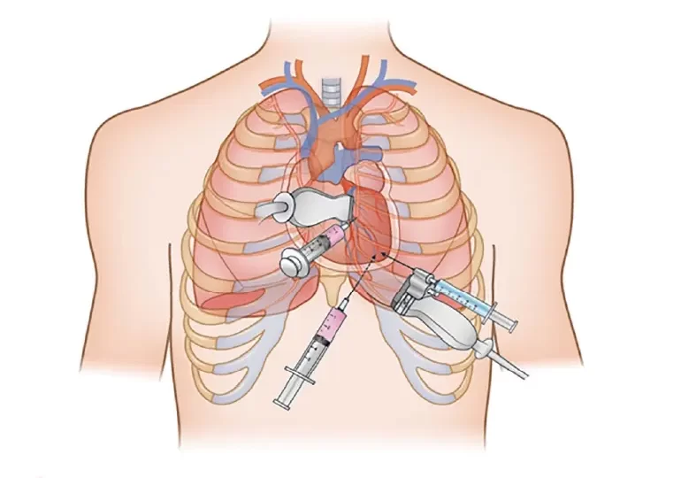 coronary artery bypass grafting surgery procedure