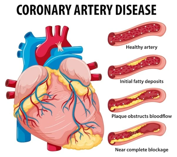 coronary artery bypass grafting surgery cost in india