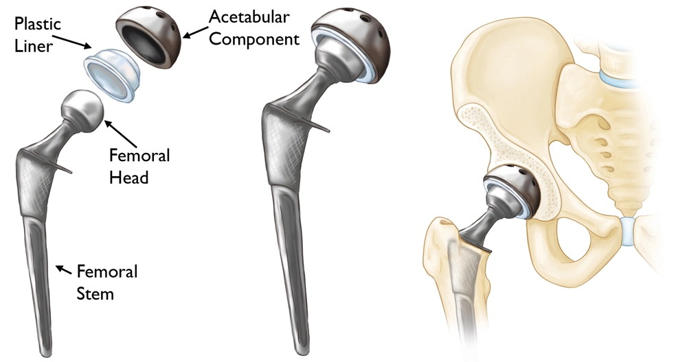 total hip replacement operation