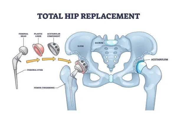 total hip replacement surgery cost in india