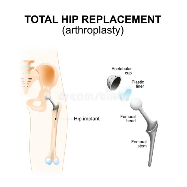 total hip replacement surgery cost in india