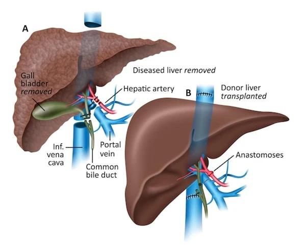 Liver Transplant Surgery Cost in India