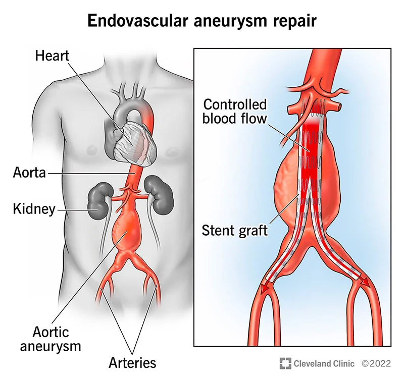 Aneurysm Repair Surgery Cost in India