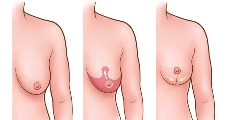 Breast Lift Cost In India