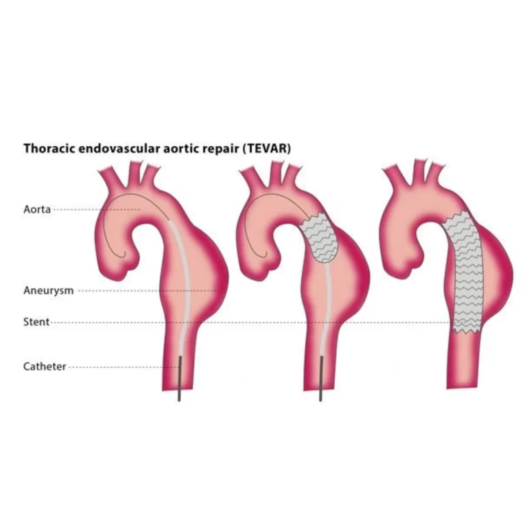 Aneurysm Repair Surgery Recovery Period