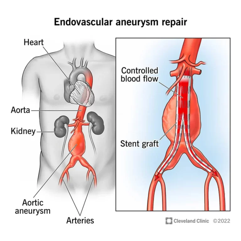 Aneurysm repair surgery survival rate