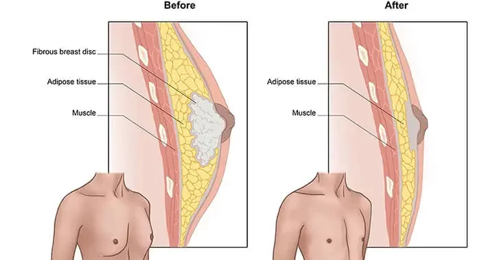 Mammoplasty Cost In India