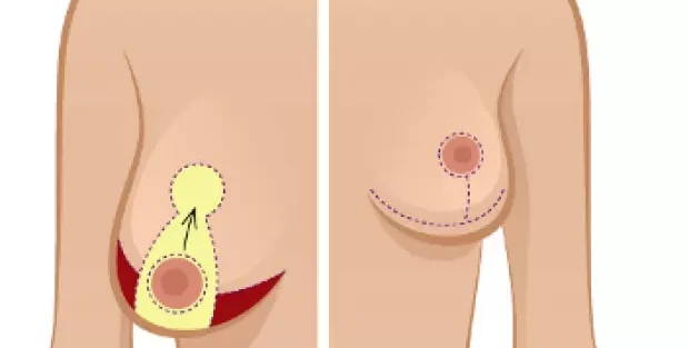 Breast Enhancement Surgery Cost