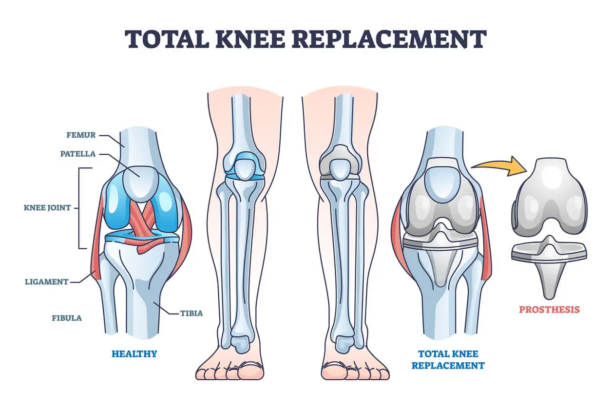 Knee Replacement operation cost