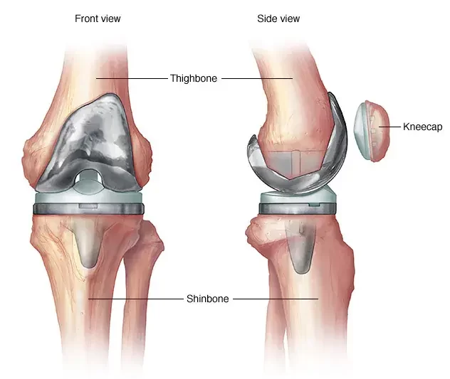 Total Knee Replacement Surgery Cost in India