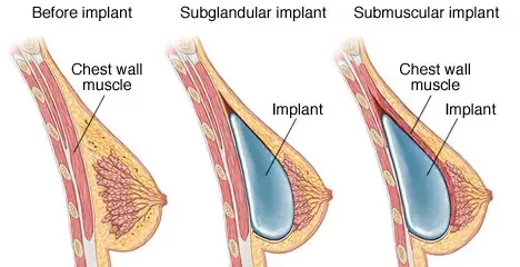 Breast Augmentation Cost In India