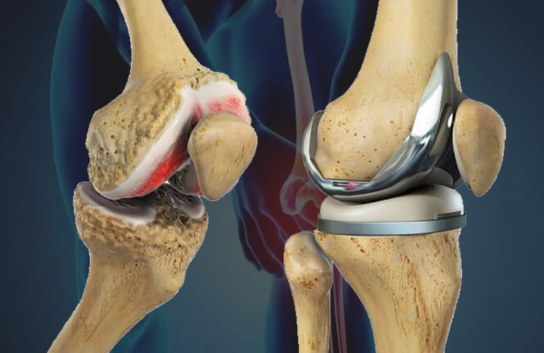 Knee Replacement Surgery Cost