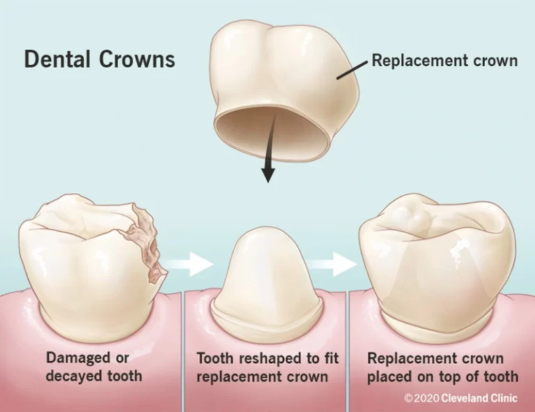 Dental Crown Surgery Cost In India