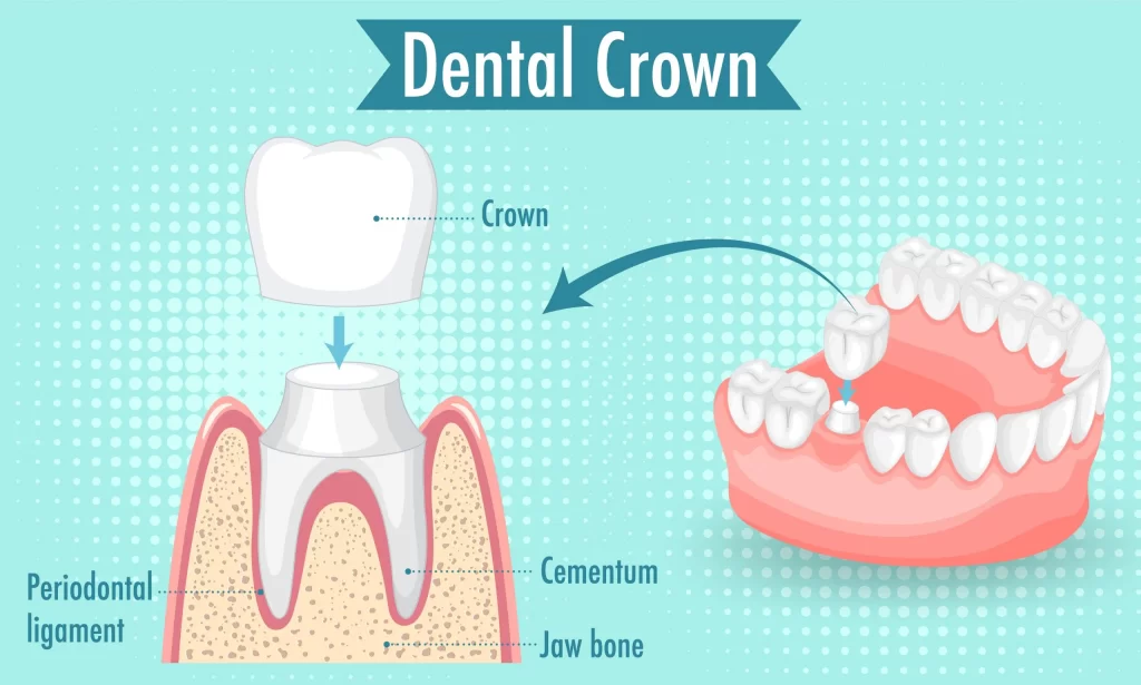 Dental Crown Surgery