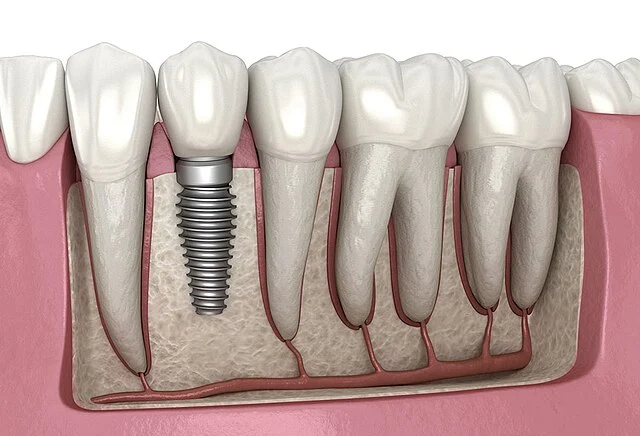 Affordable & high-quality dental implants in India for a natural smile restoration.