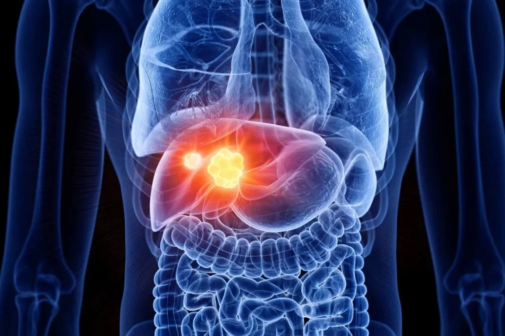 Top hospitals for liver cancer treatment in India 2025