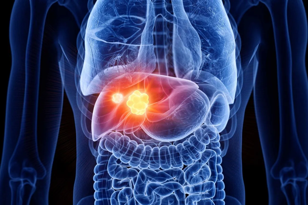 Top hospitals for liver cancer treatment in India 2025
