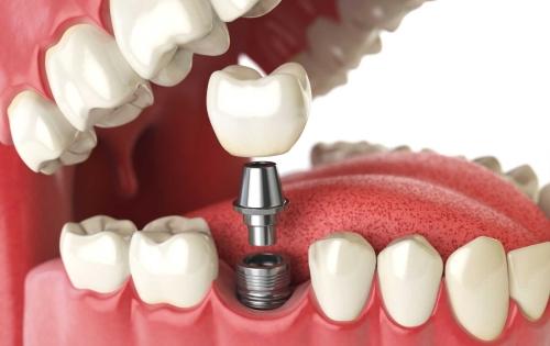 Dental Crown Reduction Surgery Cost In India