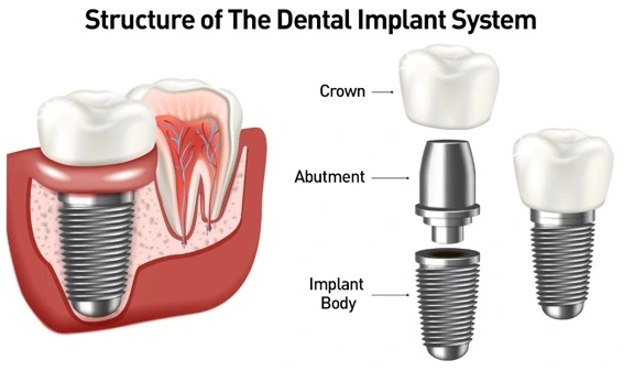 Restore missing teeth with top dental implant procedures in India at low costs.
