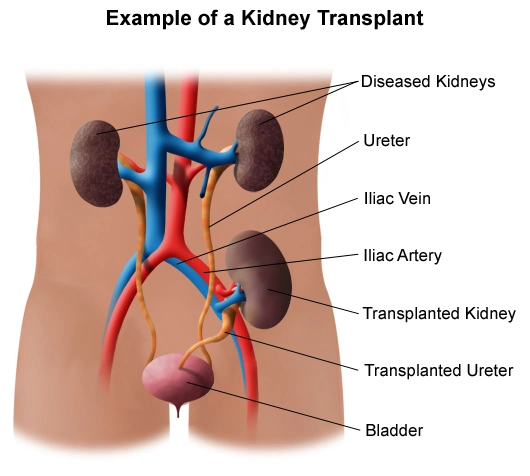 Cost breakdown of kidney transplant in India 2025