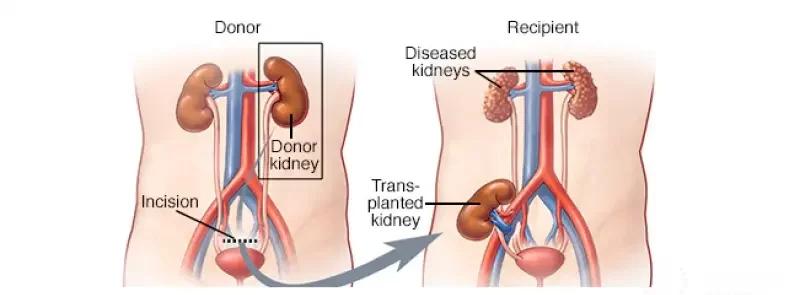 Kidney transplant cost in India for UAE patients 2025