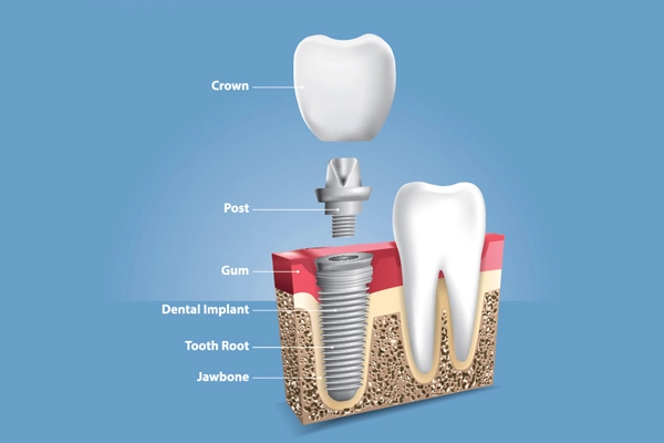 Tooth Caps Enhancement Surgery Cost