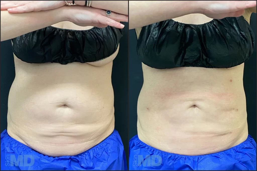 will liposuction leave loose skin