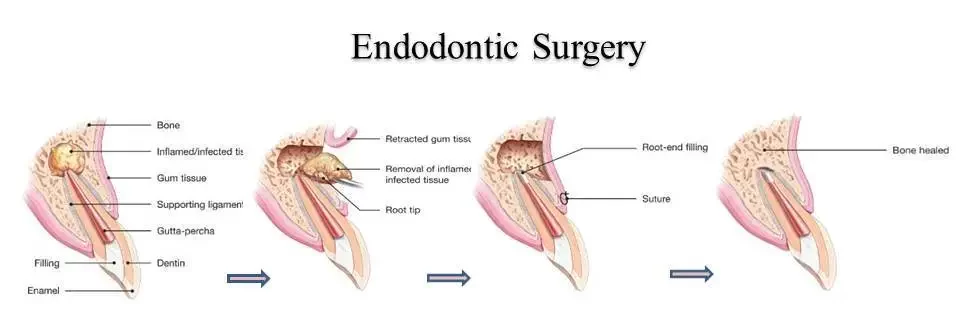 Endodontic Surgery Cost in India