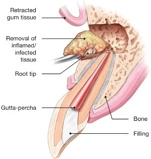 Endodontic Surgery