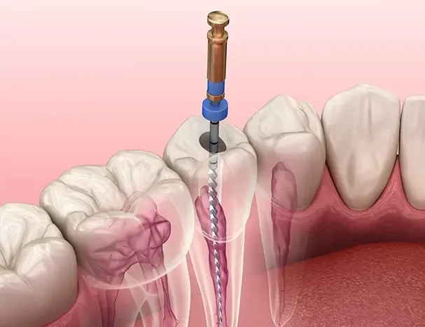 Endodontic procedure steps