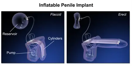 Penile Implant Surgery Cost in India