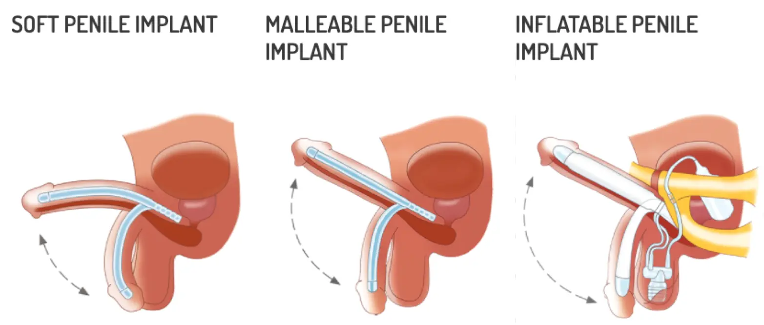 Penile Implant Surgery